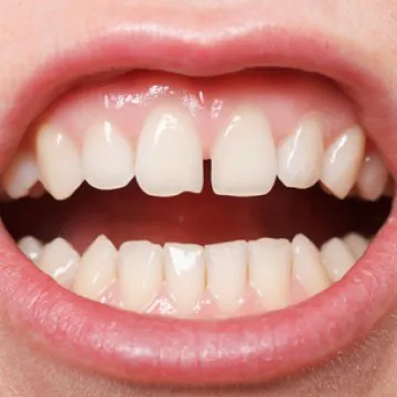 How to Fix Gaps Between Teeth