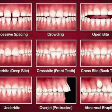 underbite overbite