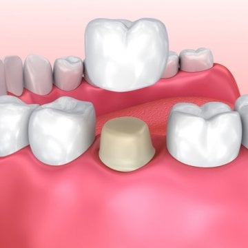 What is the Difference between Dental Crowns and Dental Veneers?
