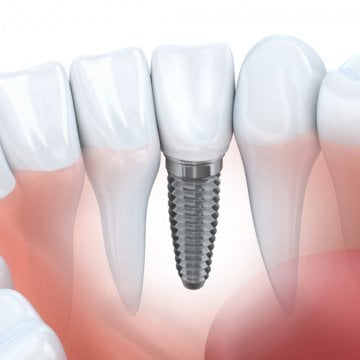 Dental Implants Abroad