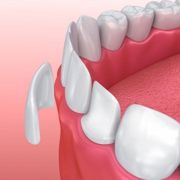What is the Difference between Dental Crowns and Dental Veneers?
