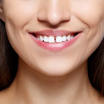How to Fix Gaps Between Teeth