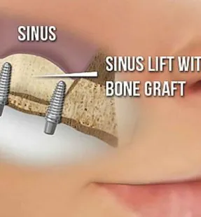 Sinus Lift Surgery: Enhancing Oral Health and Implant Success
