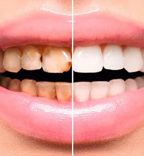 How to Fix Stained or Discoloured Teeth