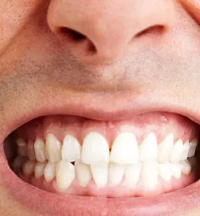 Teeth Grinding - Bruxism Treatment