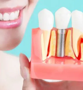 Which Dental Implant Brand Should I Choose
