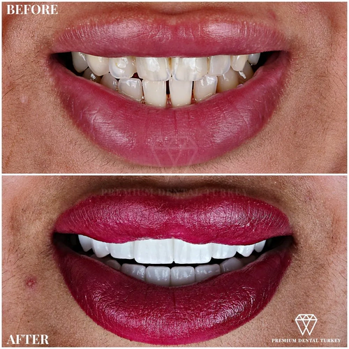 Veneers Turkey Prices for Full Set of Emax & Zirconium Porcelain Veneers