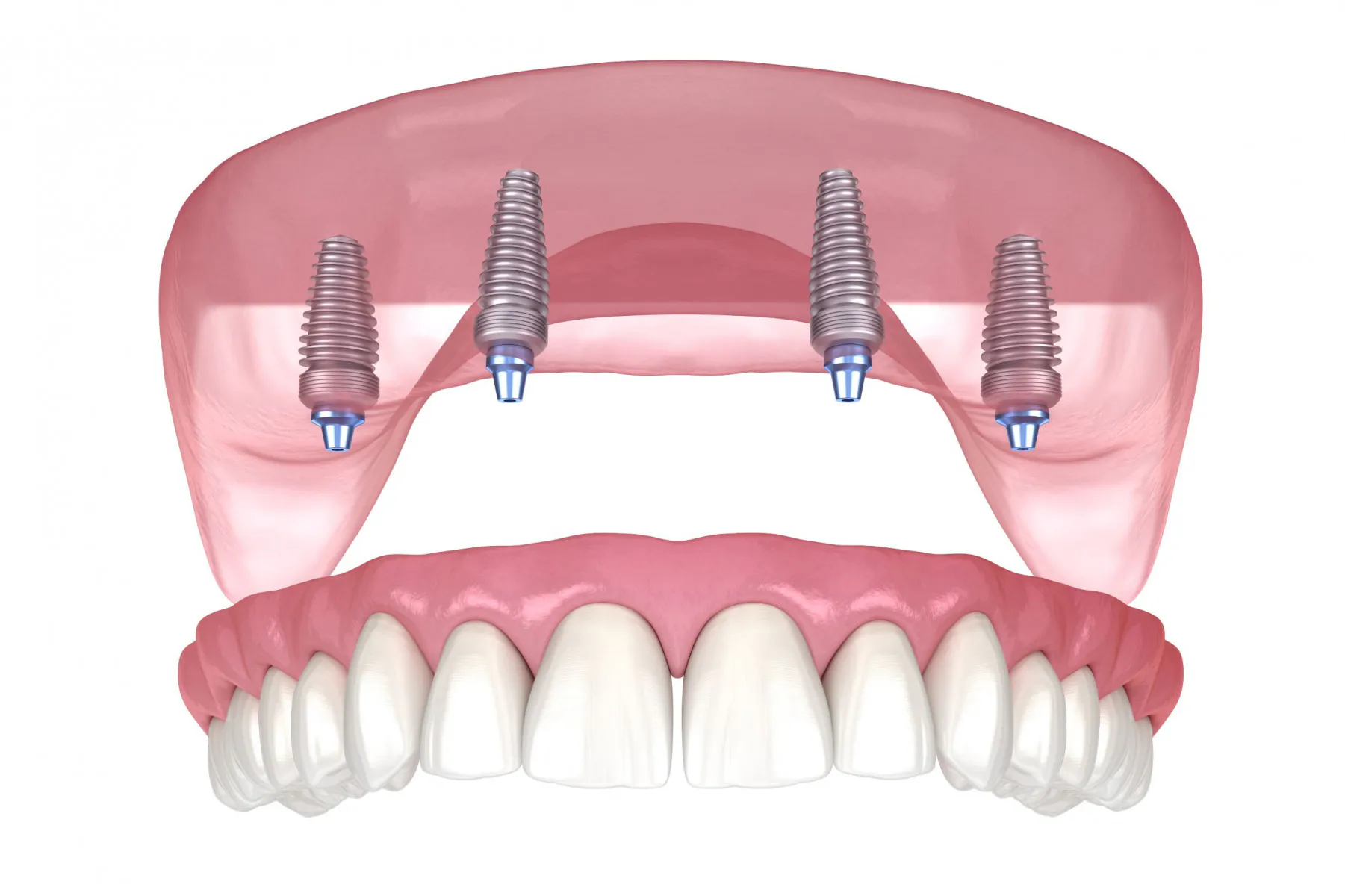 Dental Implants in Turkey Prices, Advantages. Full mouth and same day dental implants