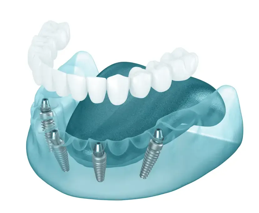 All on 4 Dental Implants Turkey