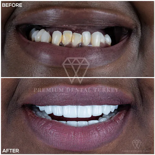 Dental Implants in Turkey Prices, Advantages. Full mouth and same day dental implants