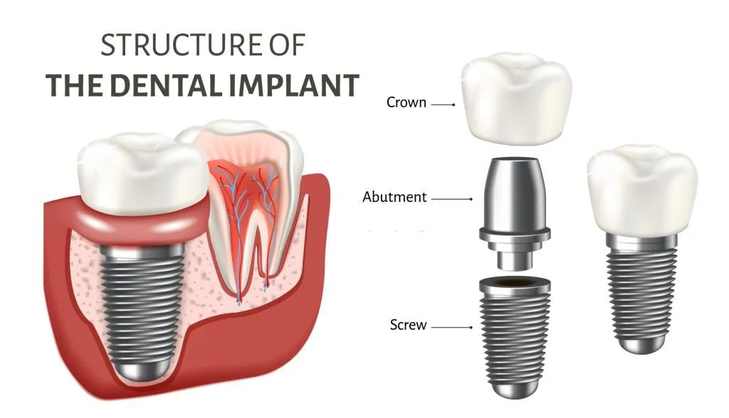 Dental Implants in Turkey Prices, Advantages. Full mouth and same day