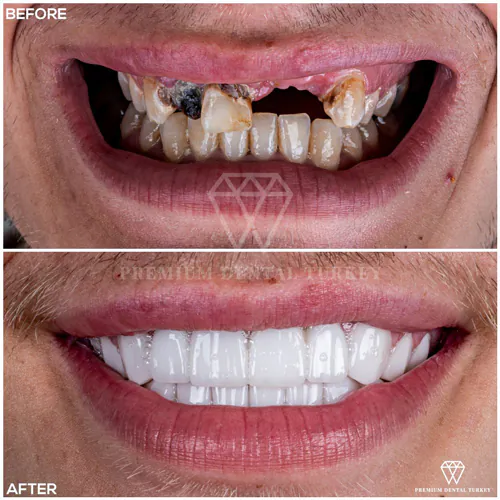 full mouth dental implants in Turkey