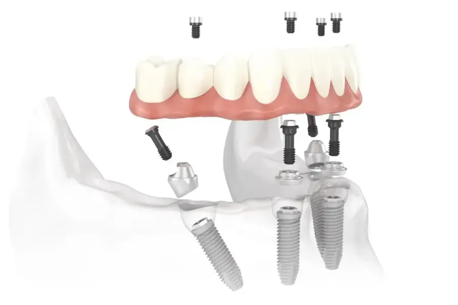 ALL ON 4 DENTAL IMPLANTS TURKEY