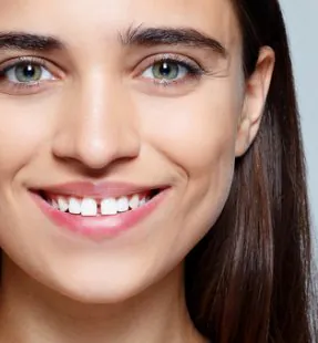 How to Fix Gaps Between Teeth