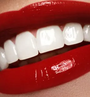 Hollywood Smile