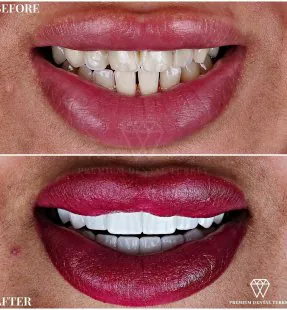 Cost of Full Set of Veneers in Turkey: Complete Guide