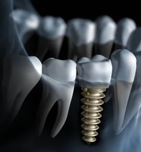 Dental Implants Abroad