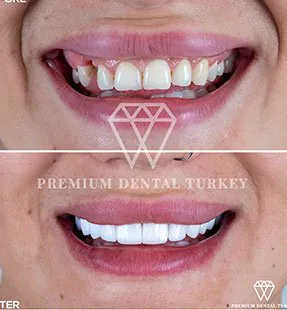 Veneers in Turkey: Understanding Costs and Benefits