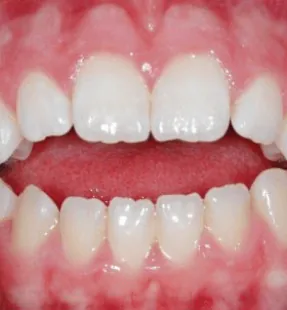 Understanding Bite Problems: From Causes to Solutions, and Exploring Dental Tourism in Turkey