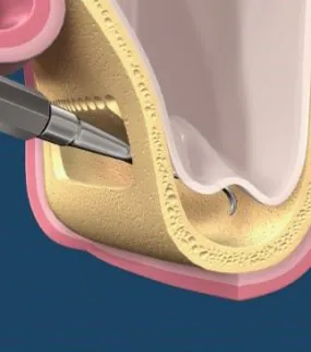 SINUS LIFTING Turkey