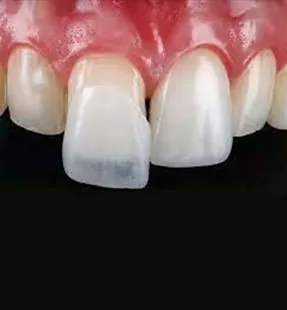 Composite Bonding or Dental Veneers: Which Is Right for You?