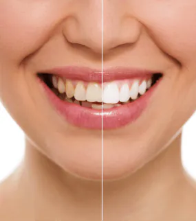 DENTAL LUMINEERS Turkey