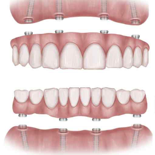 All on 4 Dental Implants Turkey