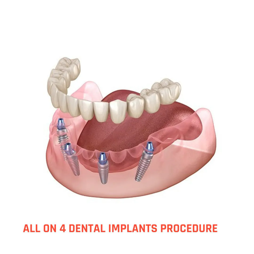 All on 4 Dental Implants Turkey