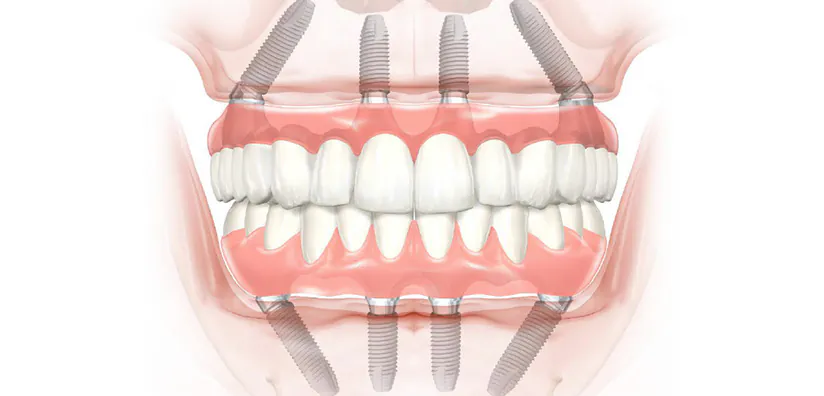 All on 4 Dental Implants Turkey