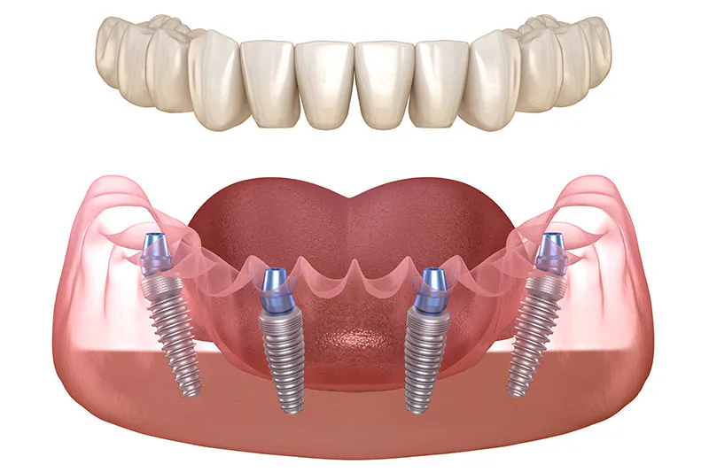 All on 4 Dental Implants Turkey
