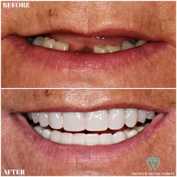 All on four dental implants in turkey