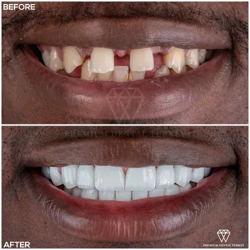 Dental Crowns Turkey