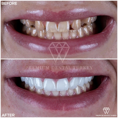 Dental Crowns Turkey