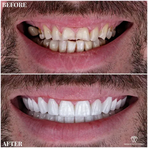Dental Crowns Turkey