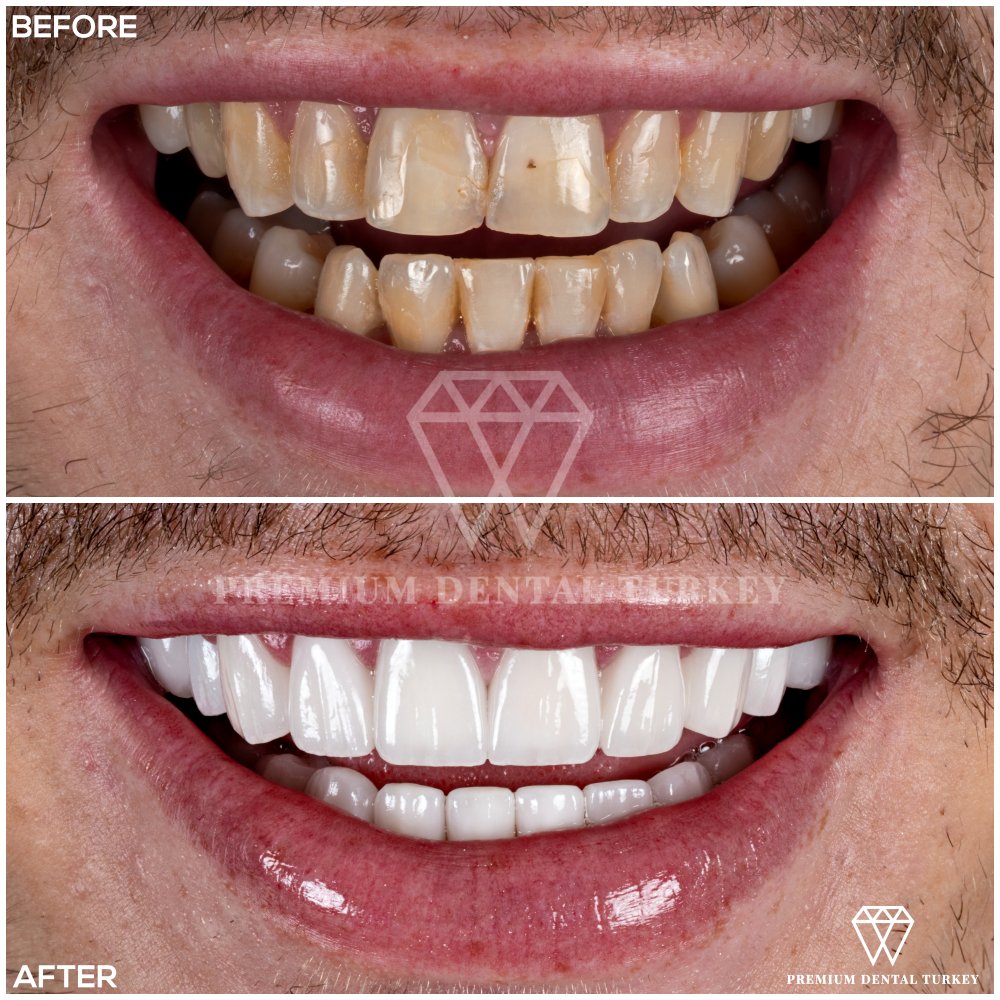 Dental Veneers Image