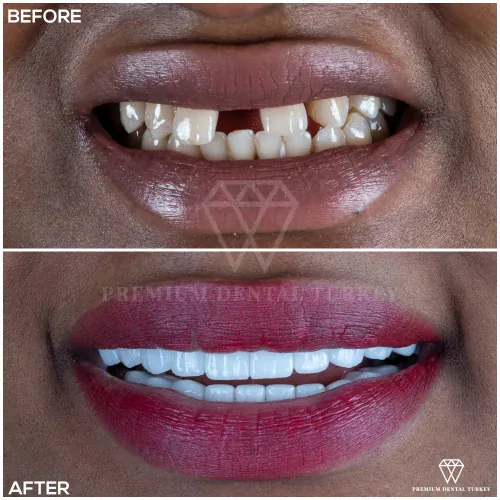 Dental Crowns Turkey