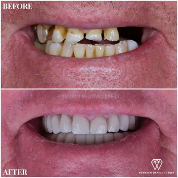 Full Mouth Reconstruction Implants in Turkey