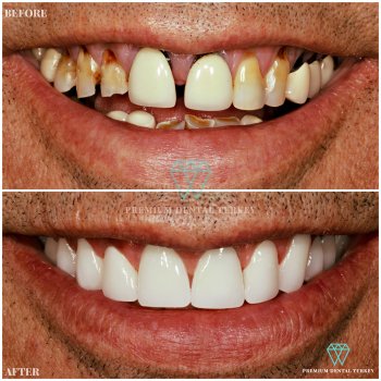 dentist in turkey