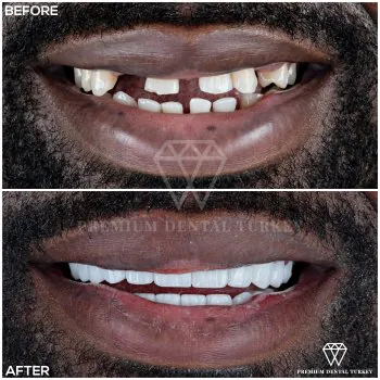 turkey teeth