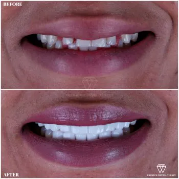 Veneer Turkey