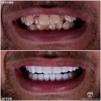 Veneers in Turkey