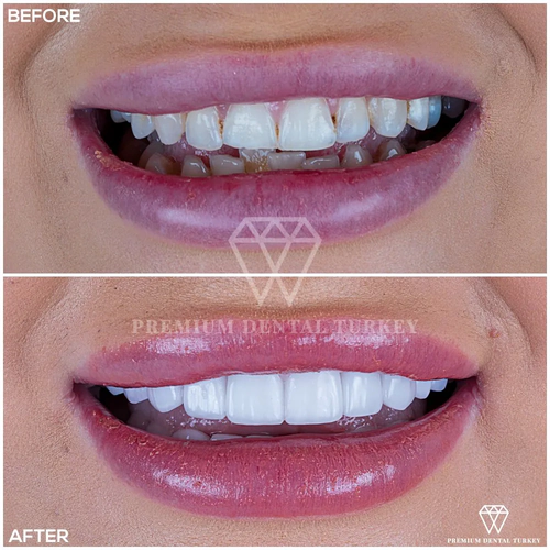Veneers in Turkey