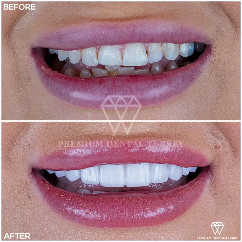 Dental Crowns Turkey