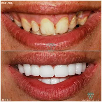 zirconium smile makeover in turkey