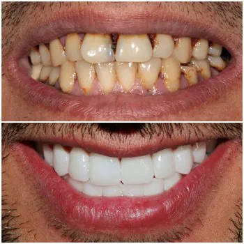 zirconium crowns premium dental turkey