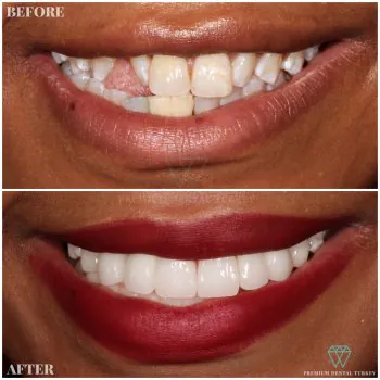 zirconium veneers before after