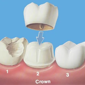 What is the Difference between Emax Crowns and Zirconium Crowns?