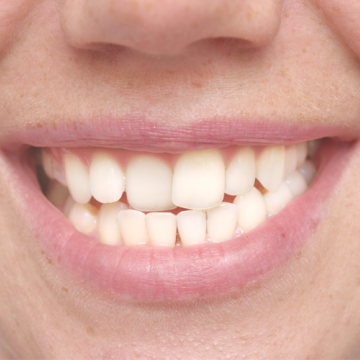How to Straighten Teeth Without Braces