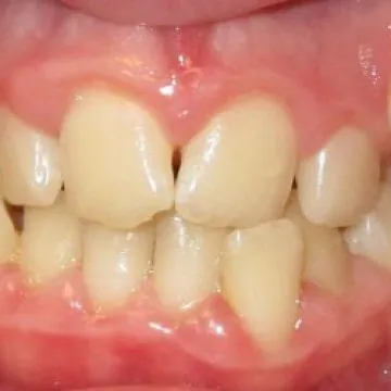 Understanding Bite Problems: From Causes to Solutions, and Exploring Dental Tourism in Turkey