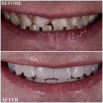 dental crowns turkey